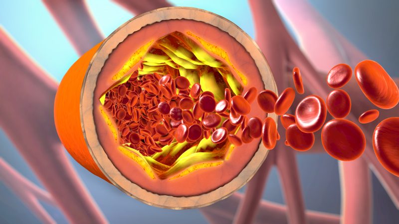 Does MCT Lower Cholesterol?
